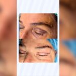 Blefaroplastica + Sopracciglio RISULTATO dopo 7 giorni rimozione punti senza dolore